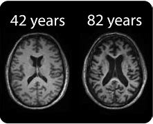 Image result for Geriatric Brain Shrinking