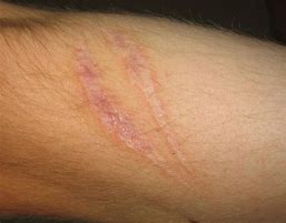 Image result for Scars On Wrist