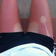 Image result for Sunburn On Legs