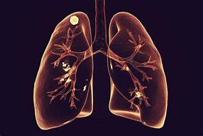 Image result for Pulmonary Nodule ACCP