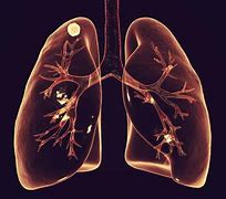 Image result for 10 mm Lung Nodule