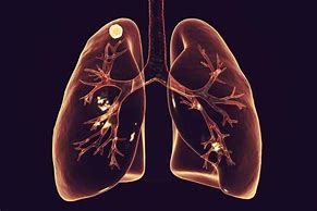 Image result for Lung Base Nodule