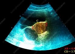 Image result for Multilocular Ovarian Cyst Ultrasound