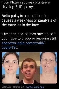 Image result for Bell's Palsy Meme