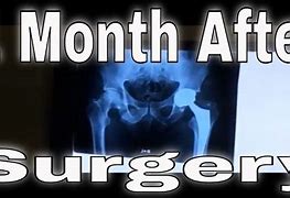 Image result for Hip Surgery Recovery