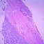 Image result for Pseudopapillary Tumor Pancreas