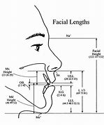 Image result for Vertical Dimension with Bruxism