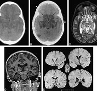Image result for Brain Uncal Herniation