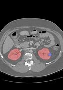 Image result for Large Kidney Tumor