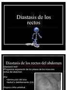 Image result for Diastasis De Los Rectos Al Nacer