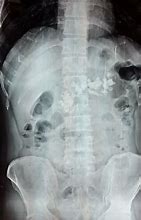 Image result for Pancreatic Calcification X-ray