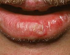 Image result for Actinic Cheilitis Lip