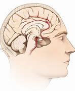 Image result for Intracranial Aneurysm