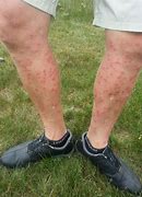 Image result for How Does Scabies Look Like