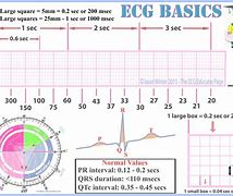 Image result for Horizontal Axis On ECG