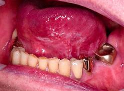 Image result for Squamous Cell Papilloma On Tongue