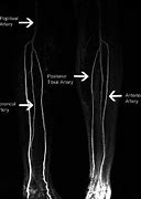 Image result for Left Leg Angiogram