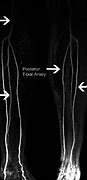 Image result for Left Lower Extremity Angiogram
