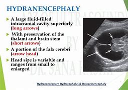 Image result for Hydranencephaly vs Normal Brain