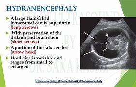 Image result for Hydranencephaly vs Hydrocephalus