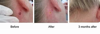 Image result for Mole Removal Healing Stages
