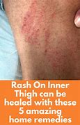 Image result for red rash treatments