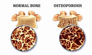 Image result for Osteoporosis Lumbar Spine