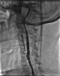 Image result for Carotid Artery Stent