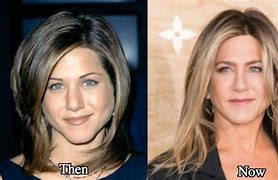 Image result for Sharp Chin Syrgery