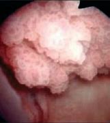 Image result for 1 Cm Tumor