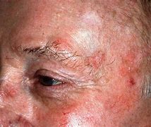 Image result for Keratosis Types