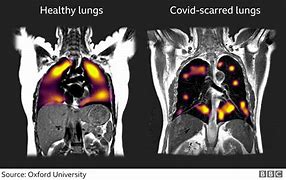 Image result for Covid Lungs