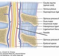 Image result for Lumbar Puncture Anatomy