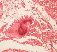 Image result for ac5inomicosis