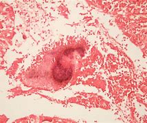 Image result for actonomicosis