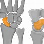 Image result for Scaphoid Pain but No Fracture
