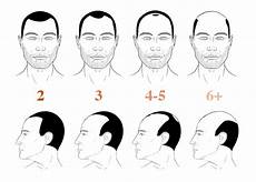 Norwood Hamilton Scale Measuring Hair Loss