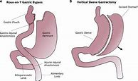 Image result for Best Type of Bariatric Surgery