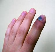 Image result for Broken Tip of Finger