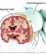 Image result for Magnetic Therapy Devices
