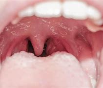 Image result for Papilloma On Uvula