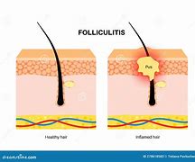 Image result for Folliculitis Cartoon