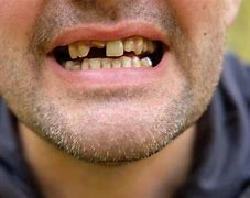 Image result for Meth Mouth
