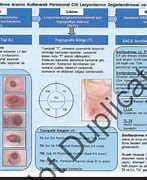 Image result for Peristomal Verrucous