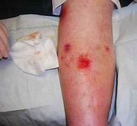 Image result for Venous Skin Ulcer