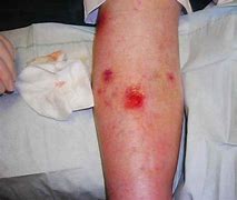Image result for Venous Skin Ulcer