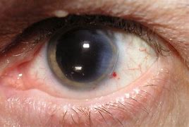 Image result for Cataract Surgery Lens