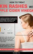 Image result for Apple Cider Vinegar Allergic Reaction