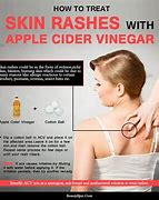 Image result for Apple Allergy Skin Rash