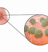 Image result for Signs of Genital Warts